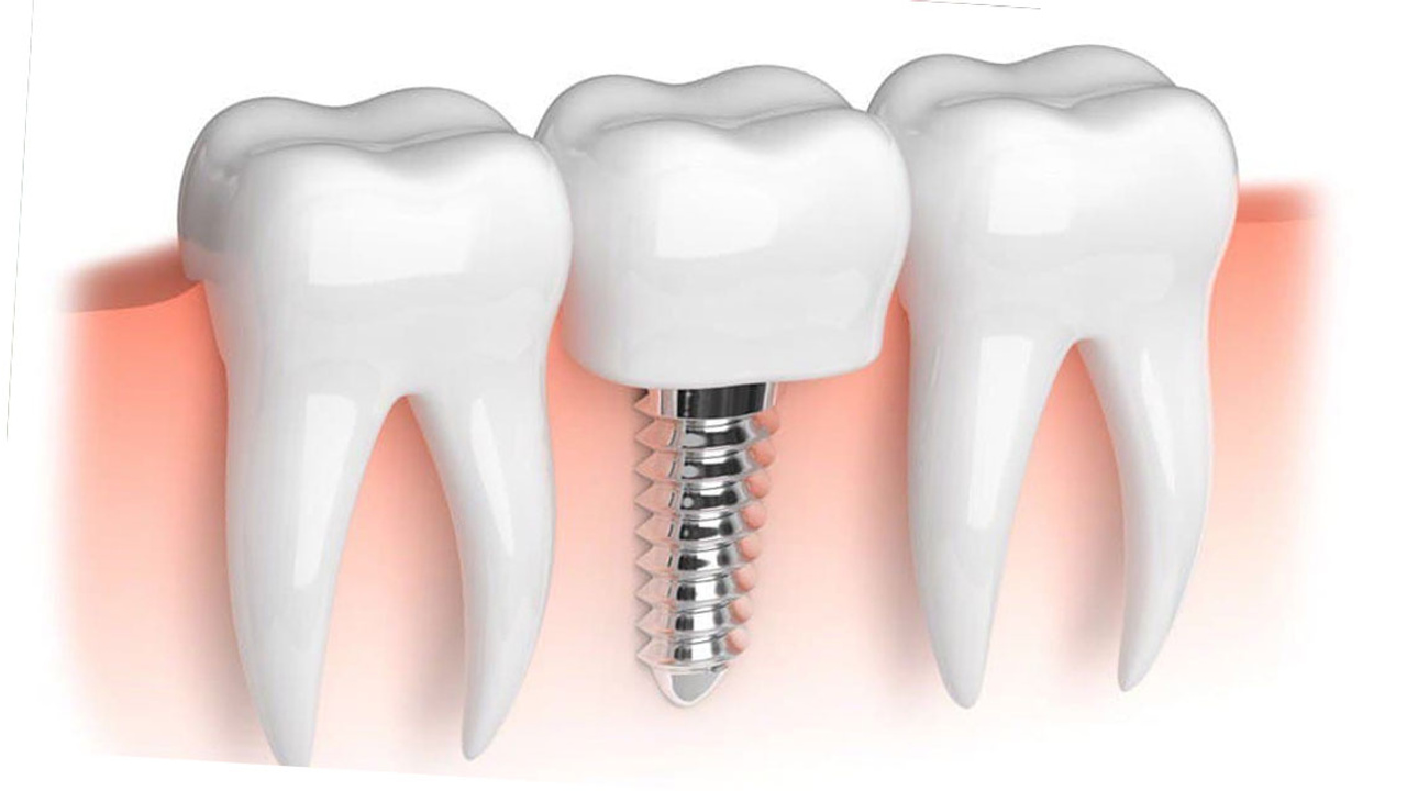 İmplant nedir nasıl yapılır?