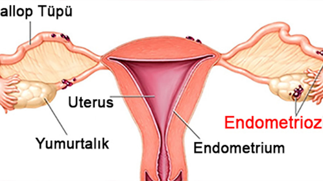 Endometriozis nedir?