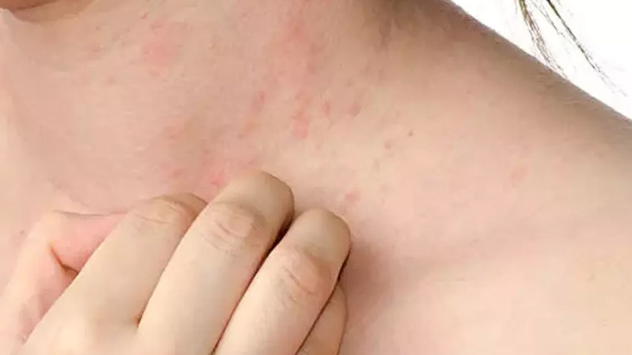 Sosyete Uyuzu nedir? Sosyete Uyuzu nasıl bulaşır? Sosyete uyuzu belirtileri nelerdir?