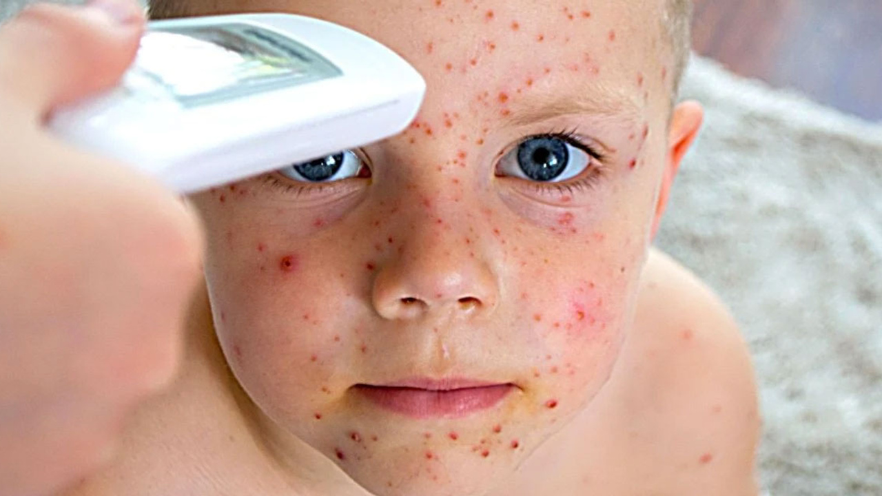 Kızamık ve boğmaca vakalarındaki artış uzmanları endişelendiriyor!