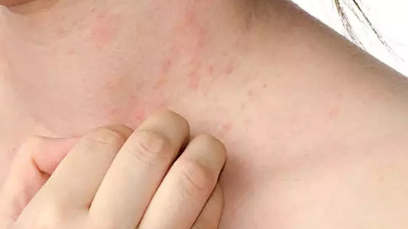 Sosyete Uyuzu nedir? Sosyete Uyuzu nasıl bulaşır? Sosyete uyuzu belirtileri nelerdir?
